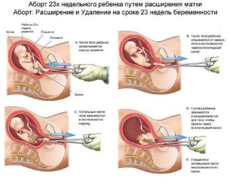 Quy trình nạo phá thai
